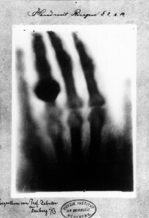 Uma das primeiras radiografias de Wilhelm RÃ¶ntgen, da mÃ£o esquerda de sua esposa.
