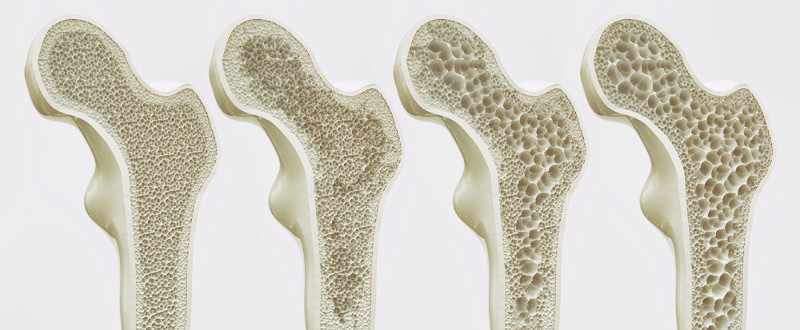 Estágios da osteoporose: mais à esquerda, tecido ósseo com maior densidade, mais à direita, tecido ósseo com menor densidade.