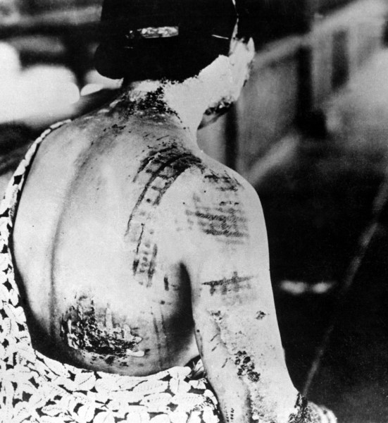 Queimaduras no corpo de uma sobrevivente da explosão da bomba atômica em Nagasaki, 1945.